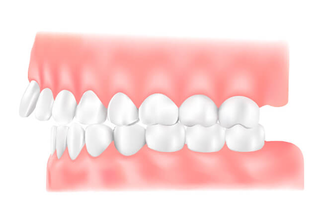 出っ歯（上顎前突）