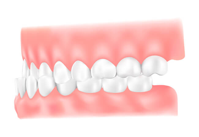 受け口（下顎前突）