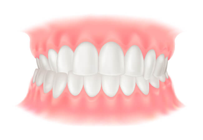 交叉咬合（こうさこうごう）