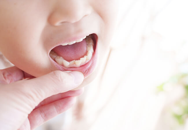 こどもの矯正歯科