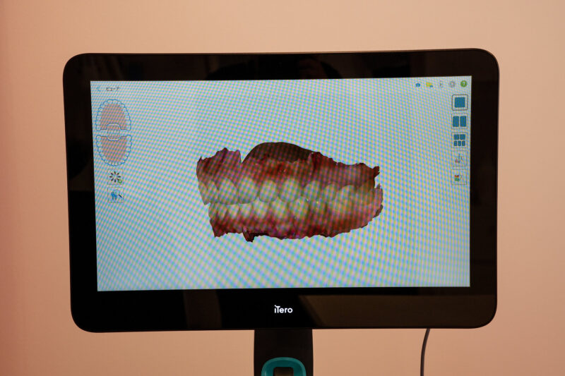 iTero（口腔内スキャナー）